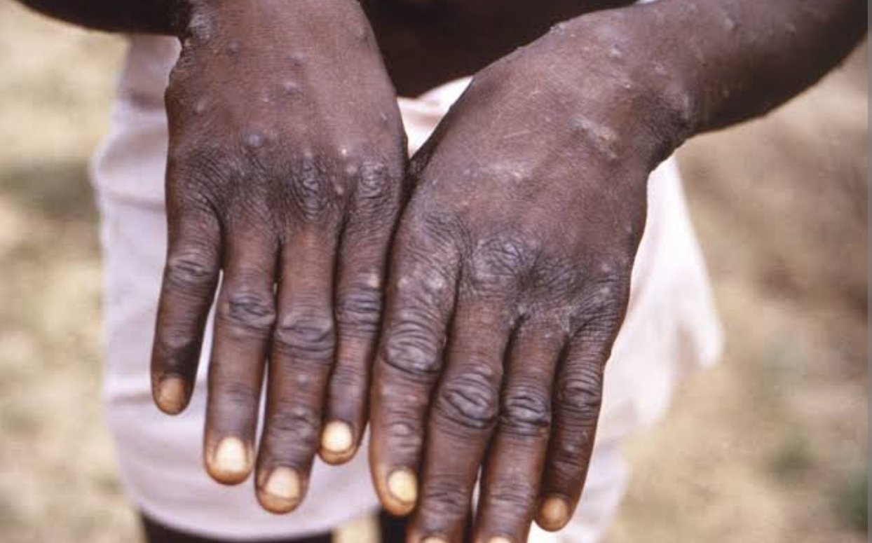 SANTÉ| 37 000 cas confirmés de MPOX signalés dans 25 pays selon OMS